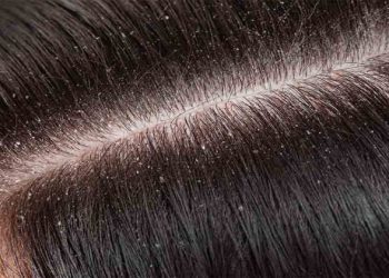 Can Dandruff Lead to Increased Hair Fall?