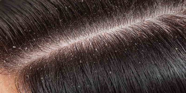 Can Dandruff Lead to Increased Hair Fall?