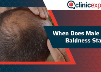 Signs of Balding & Its stages- What to do if your head becomes Bald?