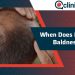 Signs of Balding & Its stages- What to do if your head becomes Bald?
