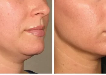 All About Skin Tightening Treatments