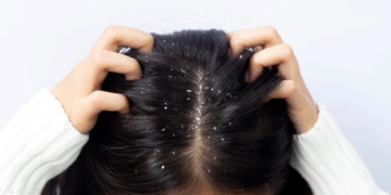 Why Dandruff is More Common in India’s Humid Climate — And How to Fight It Year-Round