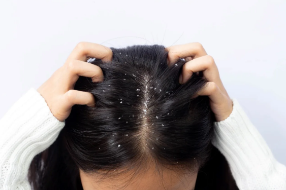 Why Dandruff is More Common in India’s Humid Climate — And How to Fight It Year-Round