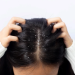 Why Dandruff is More Common in India’s Humid Climate — And How to Fight It Year-Round